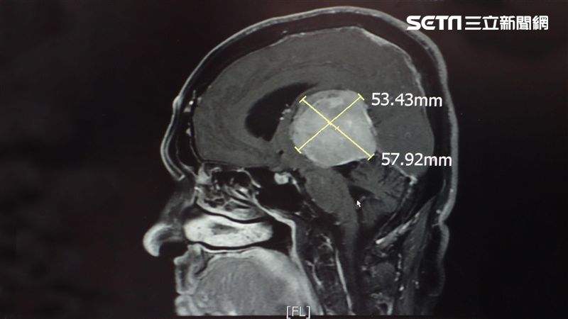 記憶力突衰退　頭內有6公分巨大腦瘤