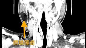 台南市,耳下腫脹,豬頭皮,影響進食,腫瘤(圖/台南市立安南醫院提供)中央社