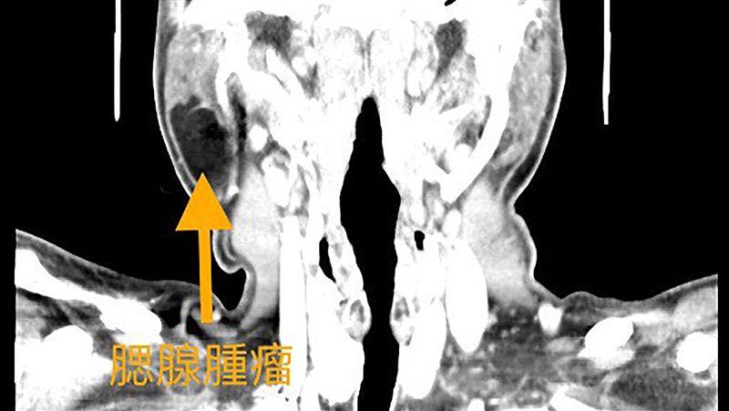 耳下腫脹誤認豬頭皮　後得知腫瘤上身