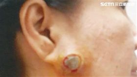 劉美玉,腮腺腫瘤,神經系統,大釣哥,腫瘤,彰化基督教醫院,陳穆寬