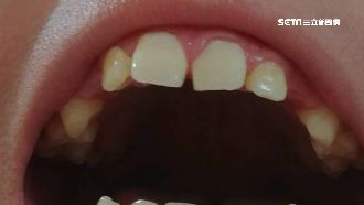 醫拔錯牙害兒漏風！父淚：他不敢笑了