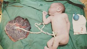 臍帶成愛心！3700克寶寶水中生產（圖／林思宏醫師授權提供）