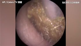 醫師用吸耳器吸出巨大耳屎。（圖／AP/Caters TV授權）