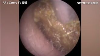 挖出十幾坨！他耳道塞大量耳屎致失聰