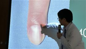 皮膚科醫師李勇毅說明指甲藏有脈絡球瘤的腫瘤症狀。（圖／記者楊晴雯攝）