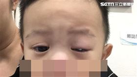 童綜合醫院,眼科,陳沛仁,出血性結膜炎,假膜
圖／院方提供