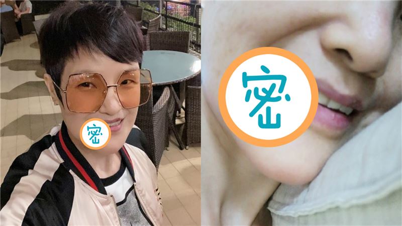 親中女星遇襲後康復　面留兩疤照曝光