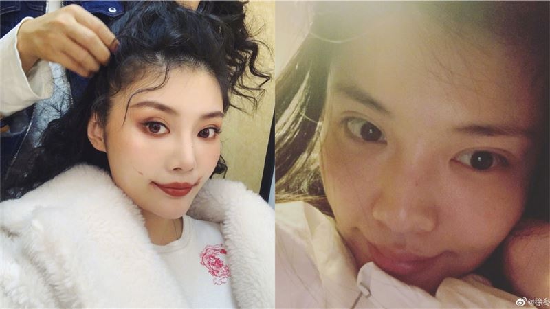 切粉瘤險死　遭質疑炒作…女星說話了