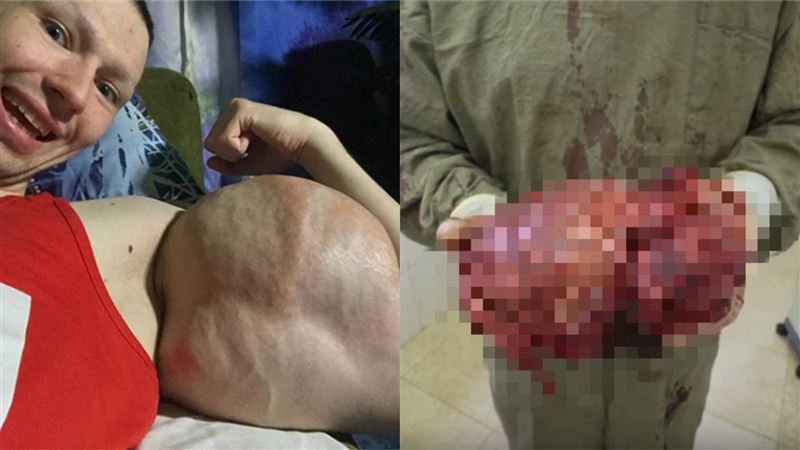 為二頭肌注3KG凡士林！他下場超慘