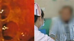 愛吃重鹹！男腸道長60多顆肉色珍珠（圖／翻攝自看看新聞）