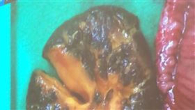 香菇,腸阻塞,開刀,腹膜炎,腸壞死