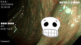 大腸息肉(陳弋)