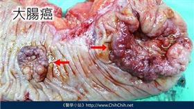 劉育志醫師提供（勿任意轉載）