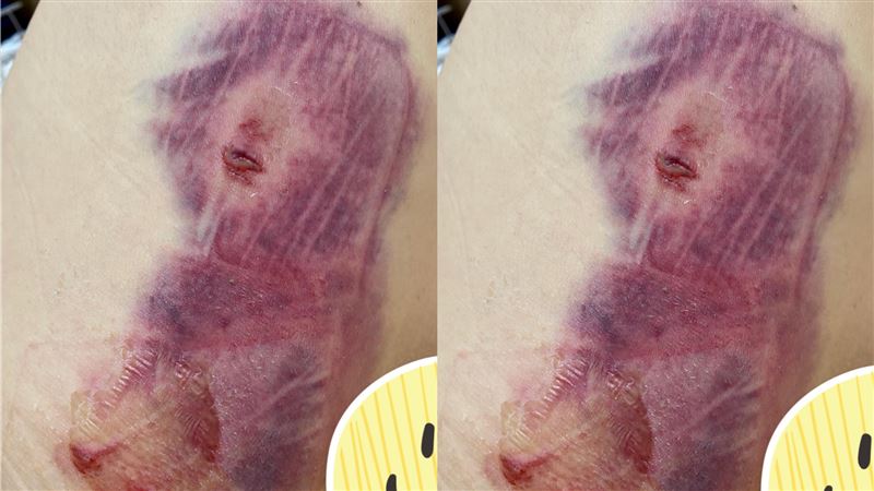 車禍女大腿浮出「血色女臉」！網嚇歪