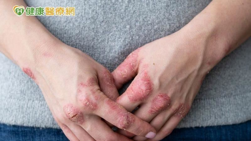 乾癬西醫治療、中醫調理　可以怎麼做