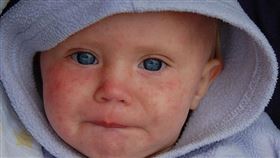 -麻疹-▲圖／攝影者Dave Haygarth, flickr CC License（https://www.flickr.com/photos/minnellium/3480352546/）