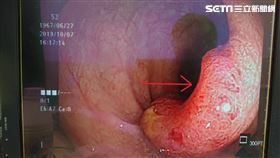 安南醫院,消化科,蔡坤峰,直腸癌,大腸癌,血便,裡急後重
圖／安南醫院提供