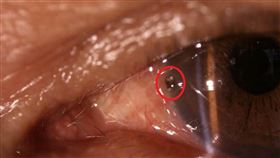 台東縣,眼睛疼痛,遠距醫療儀器,鐵屑,順利夾出(圖/衛生福利部台東醫院提供)中央社