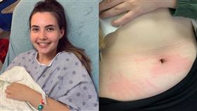 皮膚,美國,水,過敏, aquagenic urticaria,流汗,發燒,起疹,喝水,水源性蕁麻疹,水過敏 圖／翻攝自Tessa Hansen-Smith IG