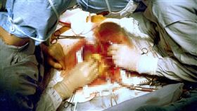 心肌梗塞(Pixabay)