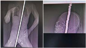 13歲男墜樓！身體遭4公尺鋼筋刺穿　「心臟一縮」逃死劫(翻攝自天眼新聞)