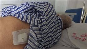 72歲翁腎結石手術！醫生「搞錯」開左腰：免費開第二次（圖／翻攝自微博）