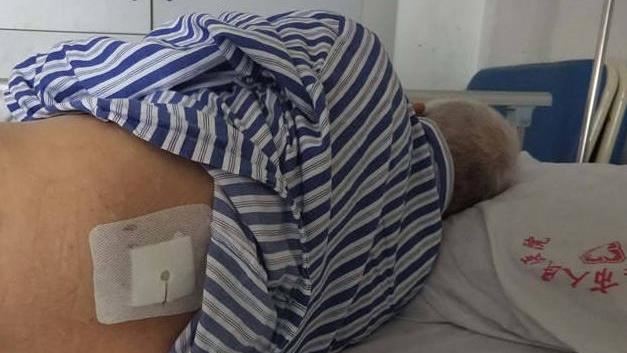翁右腎結石手術！醫生搞錯位置開左腰