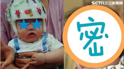 戴2萬8頭盔矯頭型　嬰冒疹恐敗血症