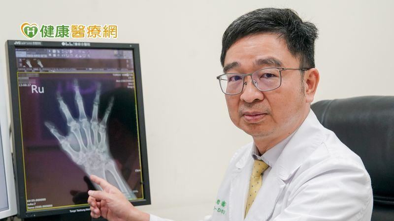 女患類風濕性關節炎　生物製劑治療