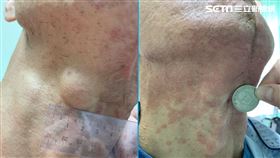 烏日林新醫院,血液腫瘤科,林增熙,口腔黏膜型惡性黑色素瘤,頷骨,惡性皮膚癌