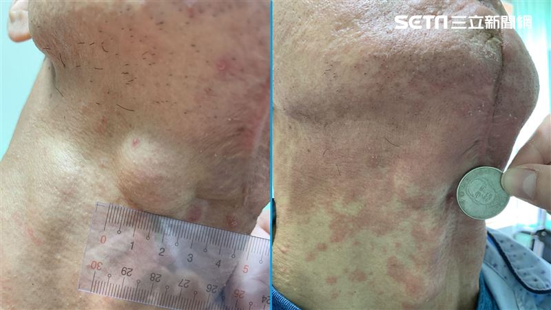 口腔冒發黑浮腫腫塊　男罹惡性皮膚癌
