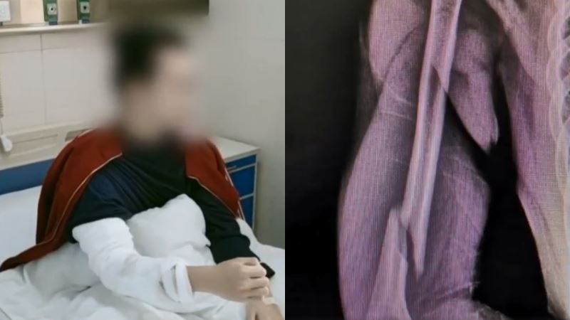 跟同學「比腕力」　下秒右臂慘變2截