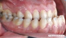 台北醫學大學口腔學院院長鄭信忠說明造成齒顎不正的原因。（圖／記者楊晴雯攝）