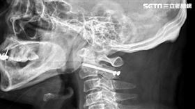 亞洲大學附屬醫院,神經創傷科,李建裕,絞刑式骨折,車禍,頸椎,骨折