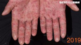 成大醫院,皮膚部,劉威廷,紅疹,腸病毒,非典型手足口病,水泡