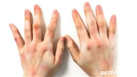 「冷凝球蛋白血症」。（圖／亞大醫院提供）