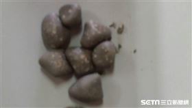 七顆結石。（圖／阮綜合醫院提供）