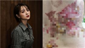 鄧莎,拔火罐,燒燙傷,驚悚。翻攝自微博