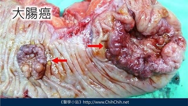 預防大腸直腸癌　懶人包一次看清楚！