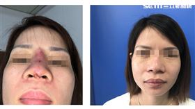 大里仁愛醫院,耳鼻喉頭頸外科,張進芳,手術,整形,整型,護膚店