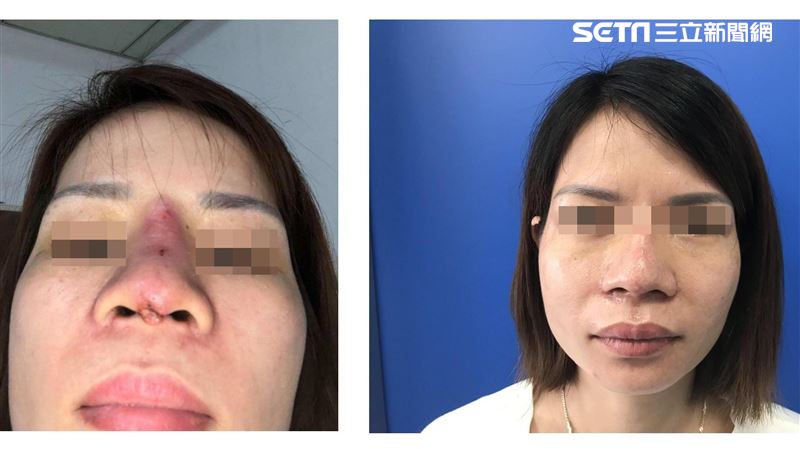 花10萬到護膚店整型　鼻爛掉如狗啃