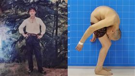 中國,深圳,僵直性脊椎炎,手術,癱瘓,躺平,睡覺,工作,經濟,疾病,治療,彎腰,　圖／翻攝自微博