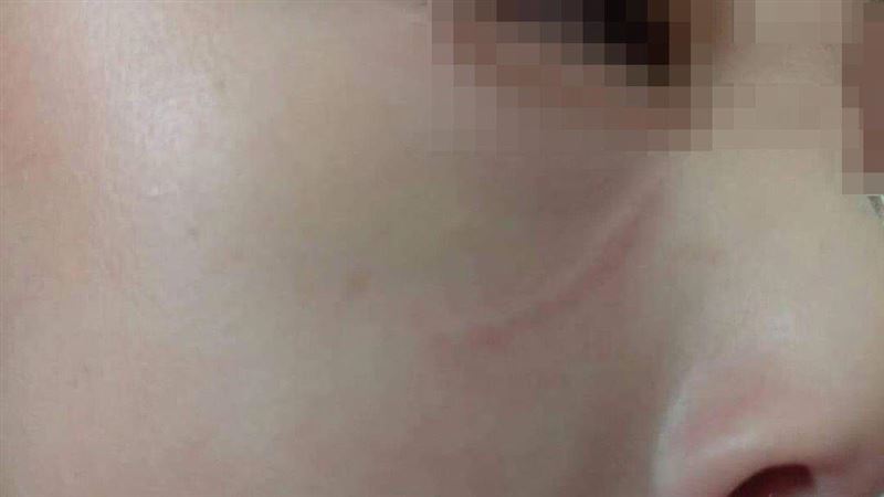 5歲兒遭掌摑、劃臉　霸凌者喊：好玩