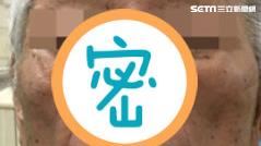 慎入！青春痘腫如松露　竟吃掉左鼻翼