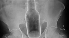 男將「18公分花露水瓶」塞肛門！醫取出後…問原因傻眼了（圖／翻攝自微博）