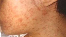 麻疹
圖／翻攝自台中市政府官網
https://www.taichung.gov.tw/8868/8872/9962/867938/post