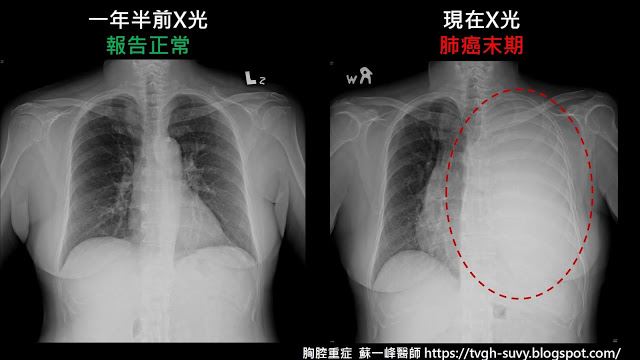寶媽也中鏢！小心肺癌會玩「捉迷藏」