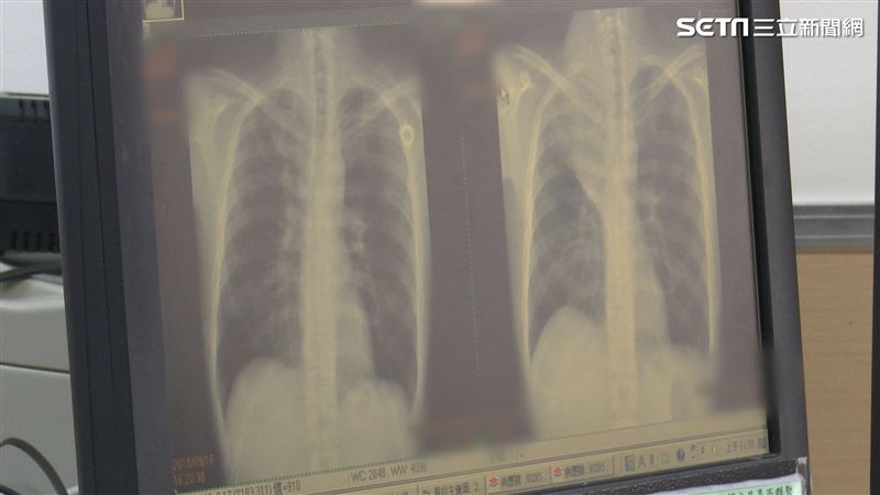 無標靶可用怎辦？免疫療法成肺癌救星