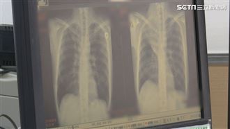 無標靶可用怎辦？免疫療法成肺癌救星