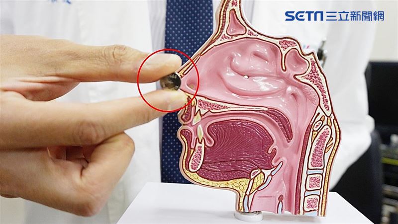 3歲男童噴深褐色惡臭鼻涕　禍首是它